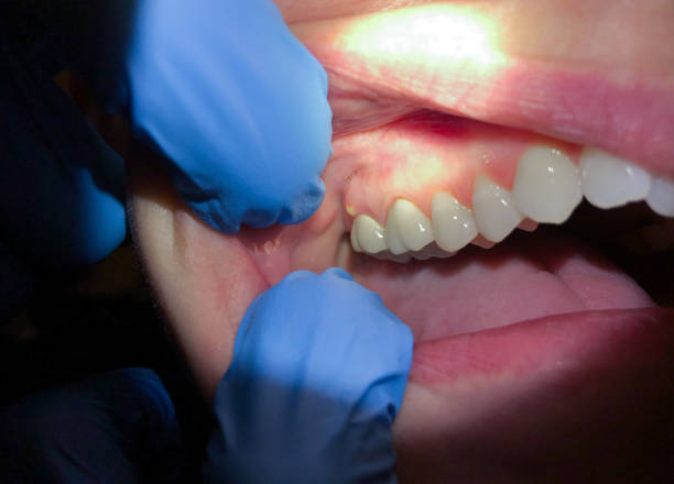 Best Emergency Root Canal Treatment in Edinburg, IL